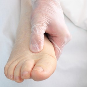 Пигментная крапивница мастоцитоз Мастоцитоз: особенности симптомов и лечения заболевания