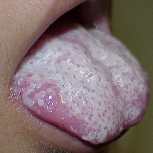 Поражение языка кандидозом Причины появления белых и красных пупырышек на языке