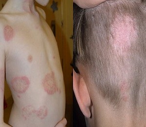 Симптомы стригущего лишая у человека Лишай у кошек: передается ли эта болезнь человеку?