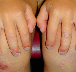 Лечение бородавок у детей Бородавки у ребенка: причины появления и лечение